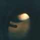 Vitrectomy Choroidal Mass